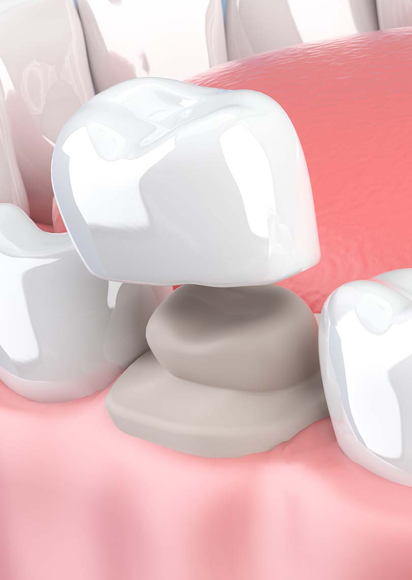 Treatment - Denpure Dental