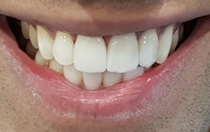 After - Denpure Dental