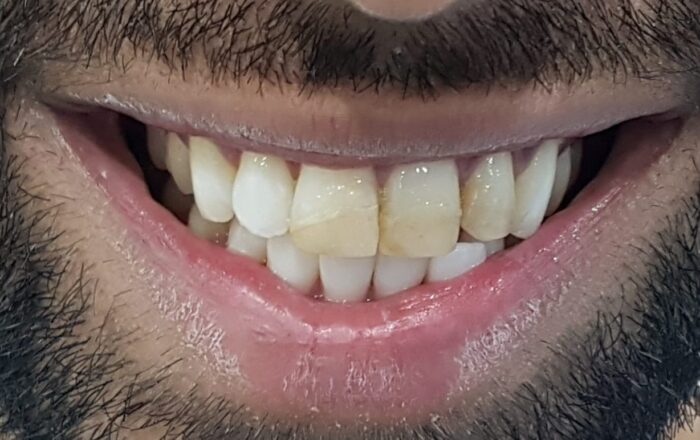 Before - Denpure Dental