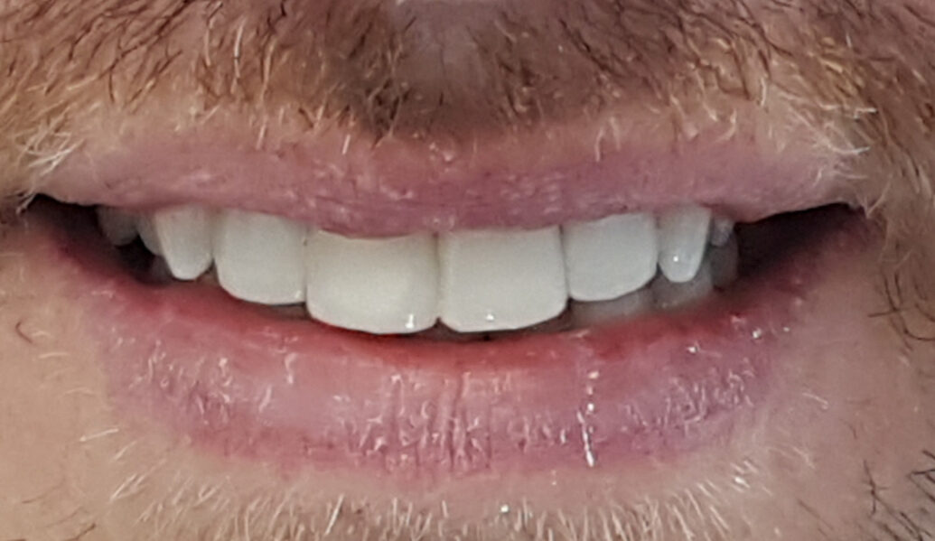 After - Denpure Dental