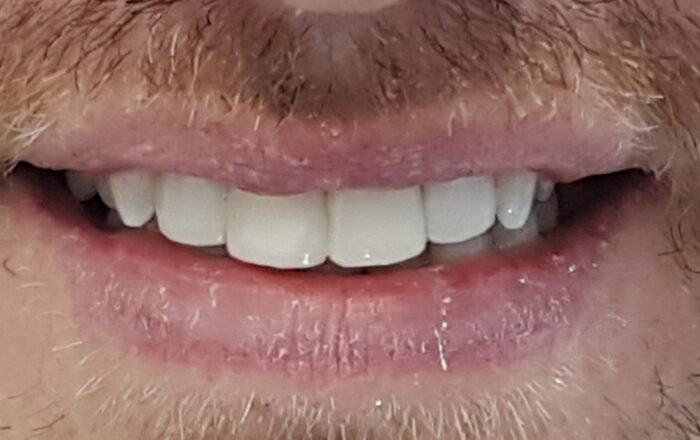 After - Denpure Dental