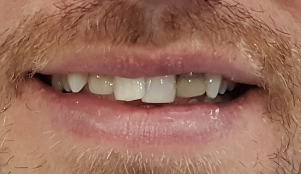 Before - Denpure Dental