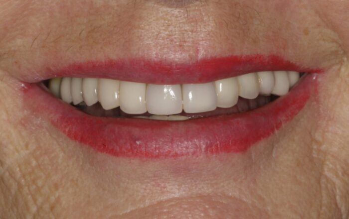 After - Denpure Dental