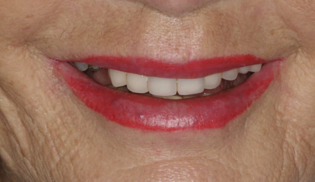 Before - Denpure Dental