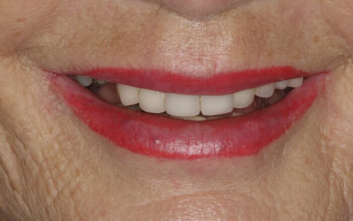 Before - Denpure Dental