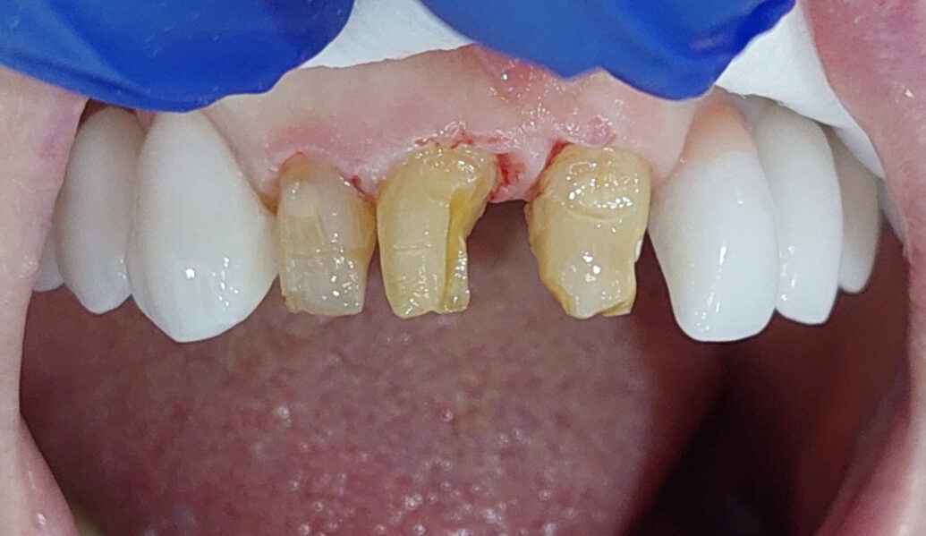 Before - Denpure Dental