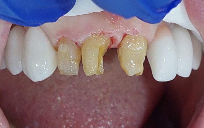 Before - Denpure Dental