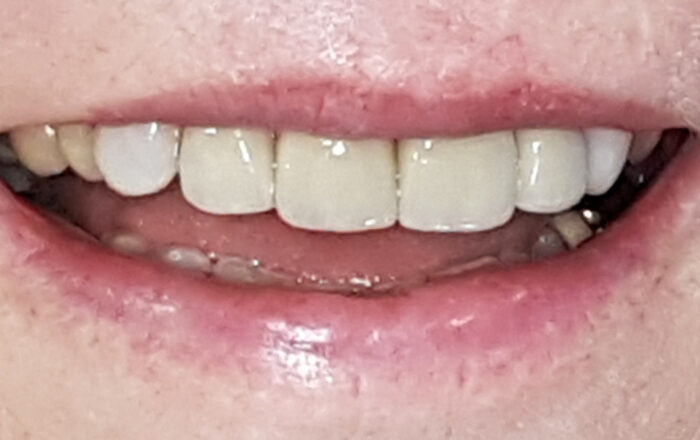 After - Denpure Dental