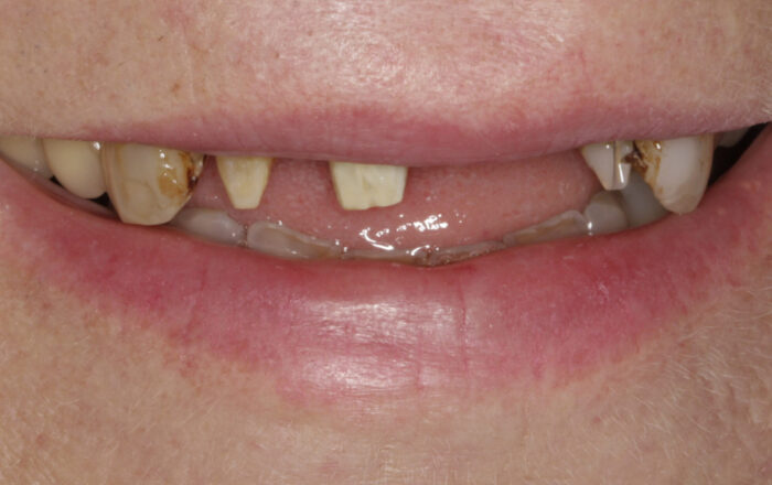 Before - Denpure Dental