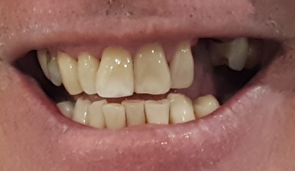 Before - Denpure Dental