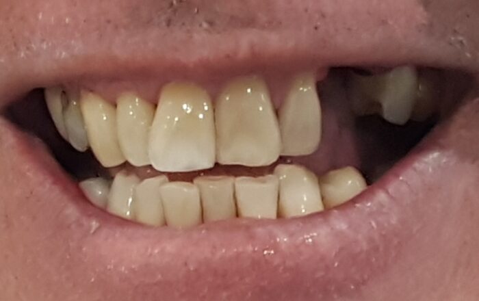 Before - Denpure Dental