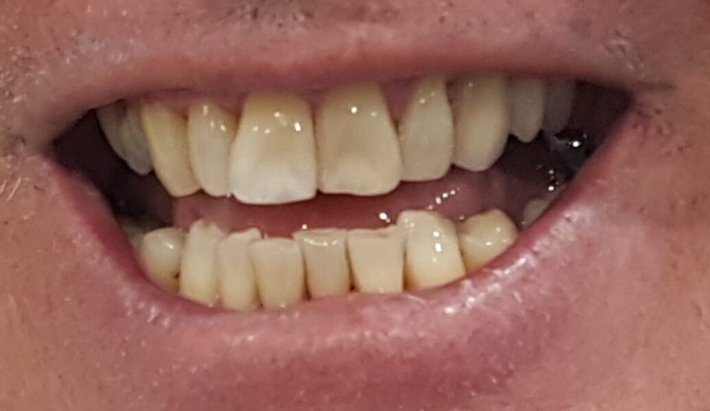 After - Denpure Dental