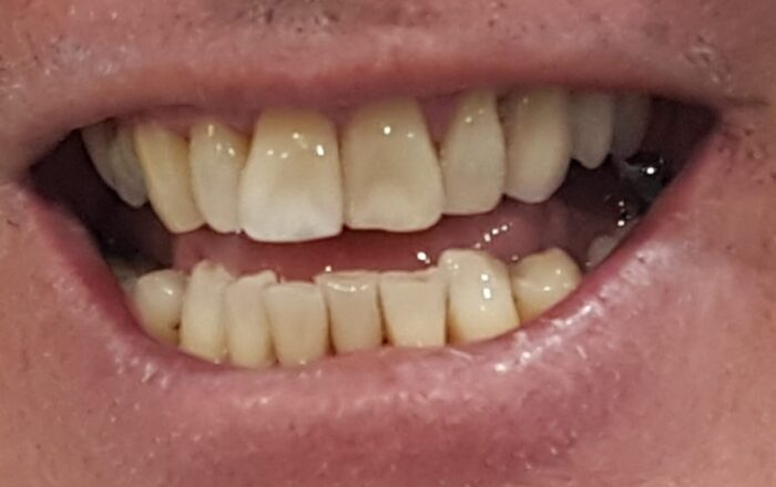 After - Denpure Dental