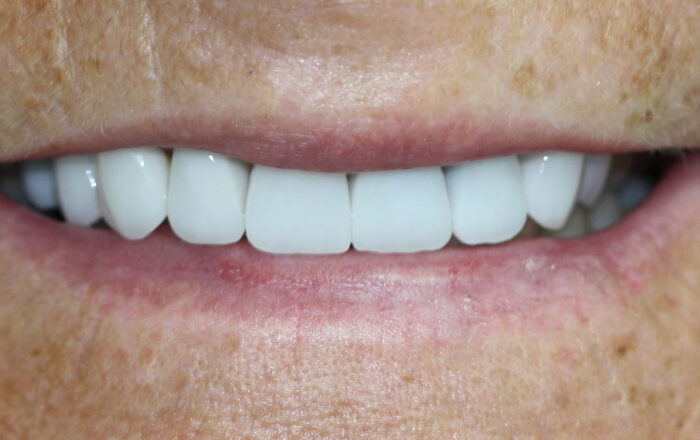 After - Denpure Dental