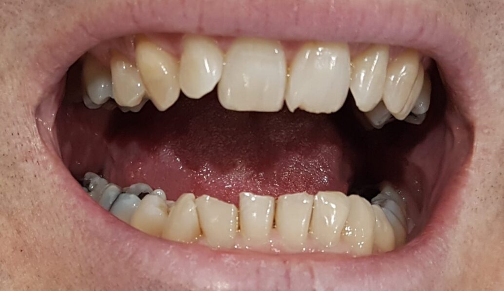 Before - Denpure Dental