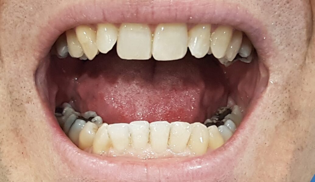 After - Denpure Dental