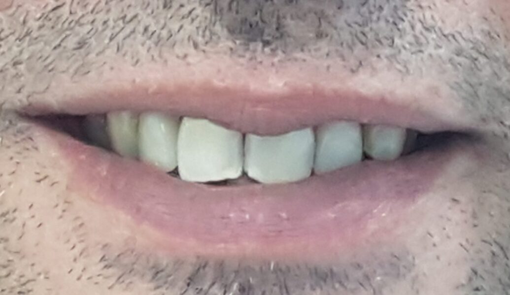 After - Denpure Dental
