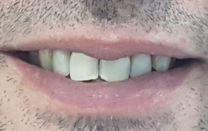 After - Denpure Dental