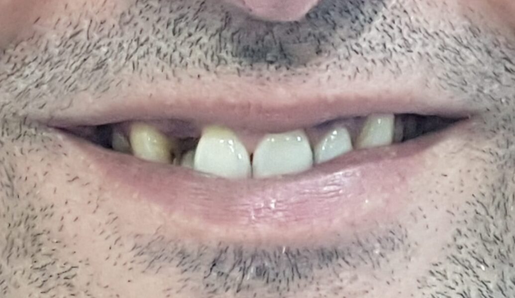 Before - Denpure Dental