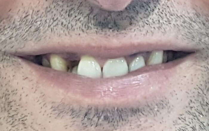 Before - Denpure Dental