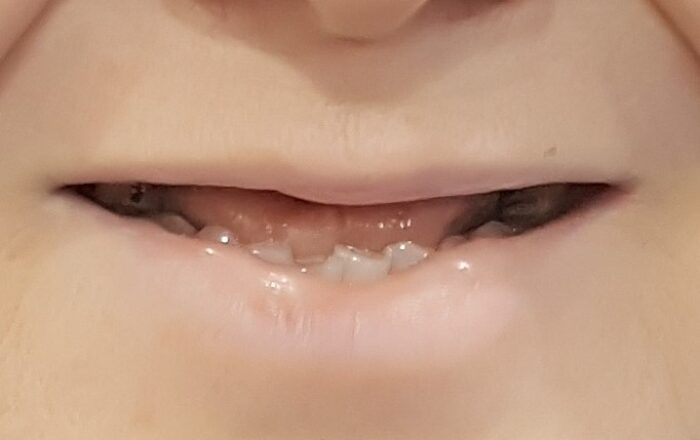 Before - Denpure Dental