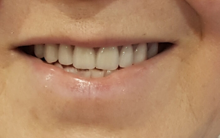 After - Denpure Dental