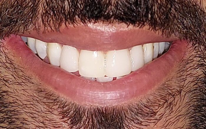 After - Denpure Dental