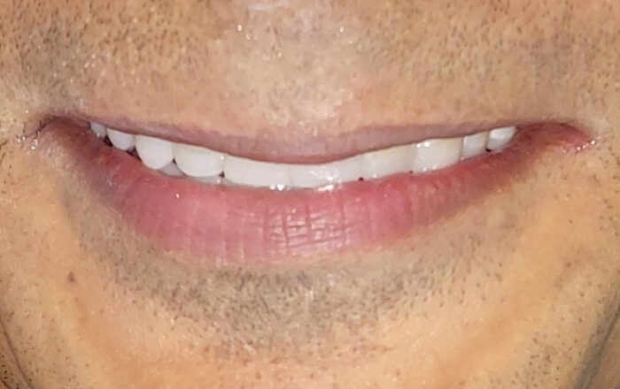 After - Denpure Dental