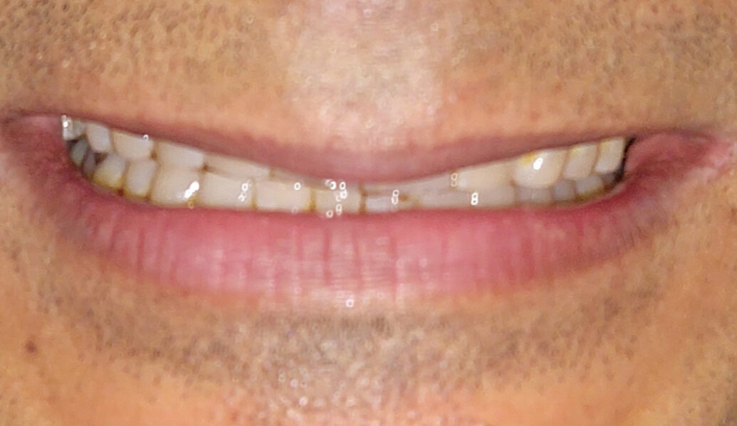 Before - Denpure Dental