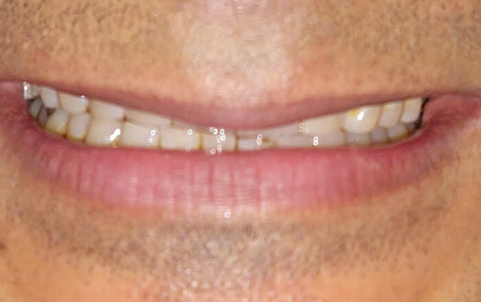 Before - Denpure Dental