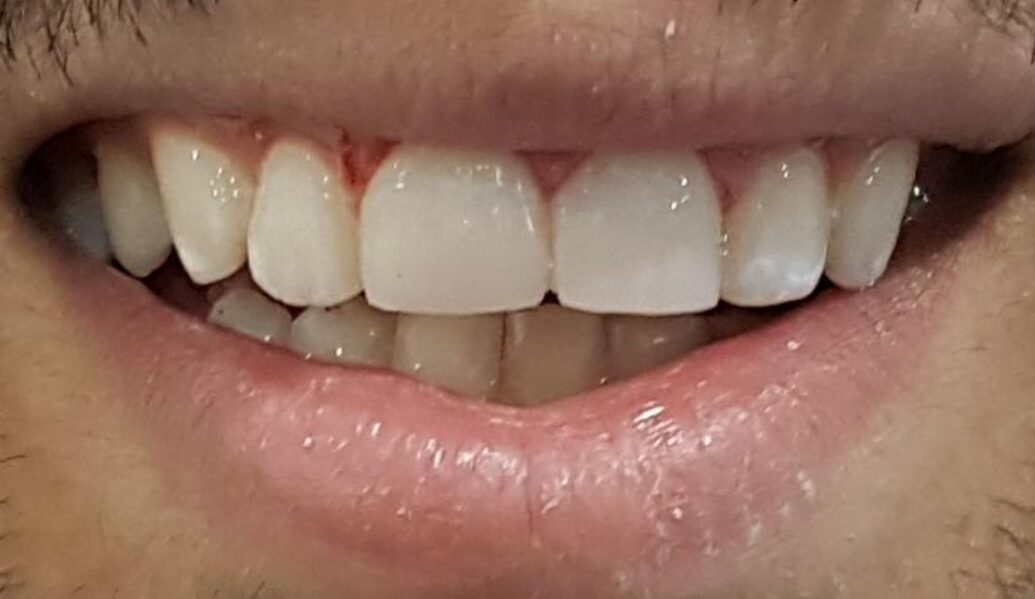 After - Denpure Dental