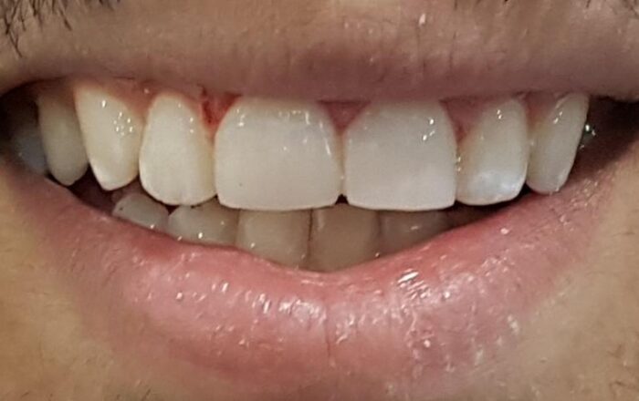 After - Denpure Dental