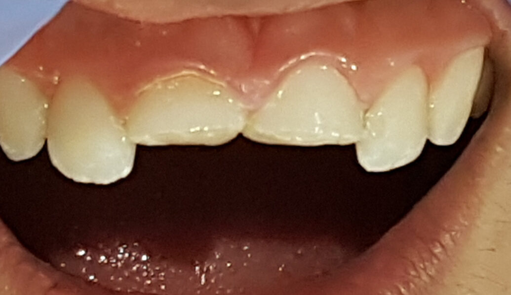 Before - Denpure Dental