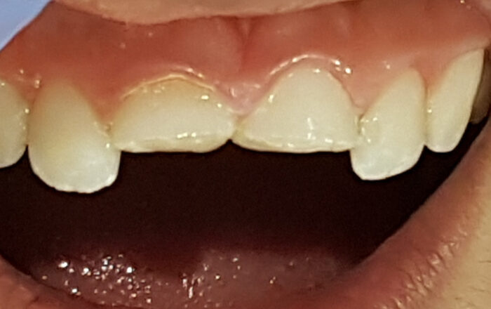 Before - Denpure Dental