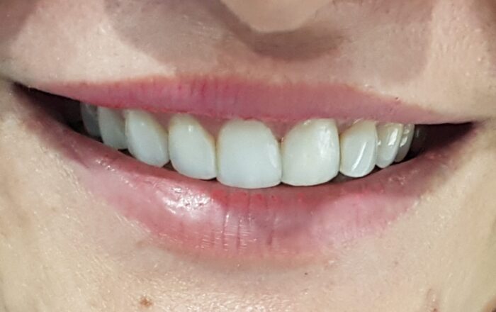 After - Denpure Dental