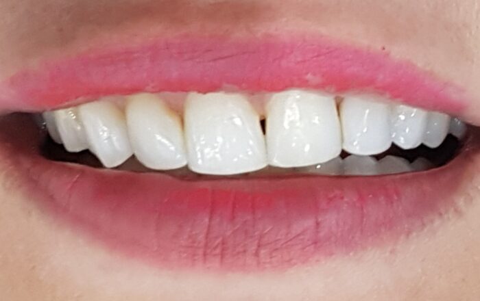 Before - Denpure Dental