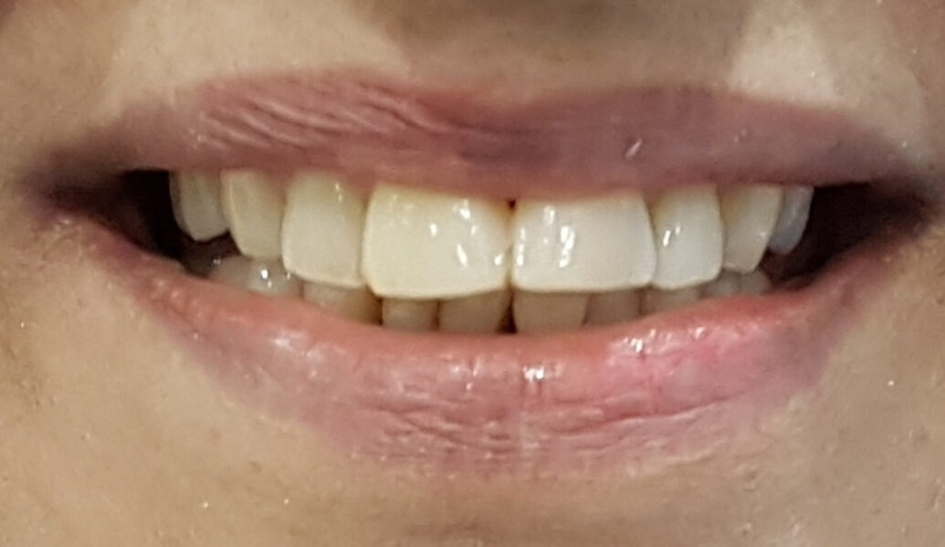 After - Denpure Dental