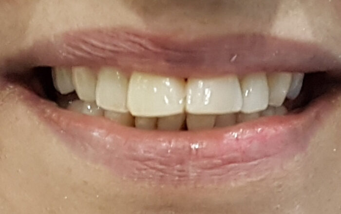 After - Denpure Dental