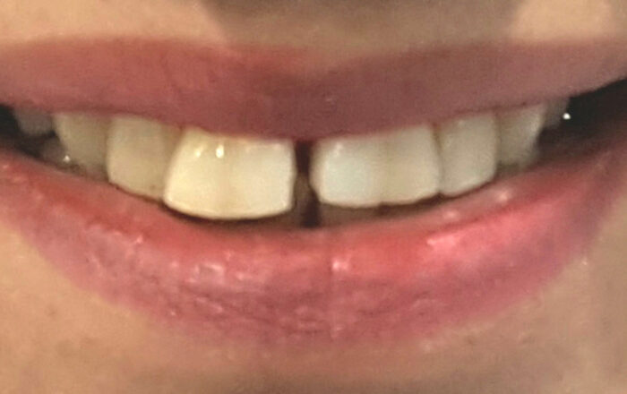 Before - Denpure Dental