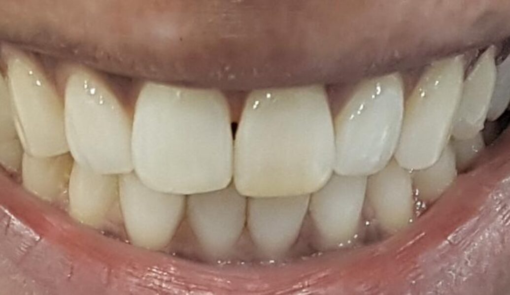 After - Denpure Dental