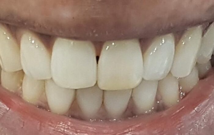 After - Denpure Dental