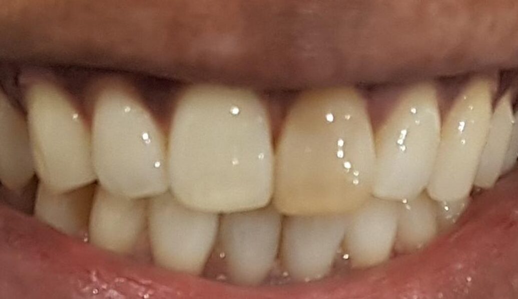 Before - Denpure Dental