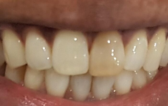 Before - Denpure Dental