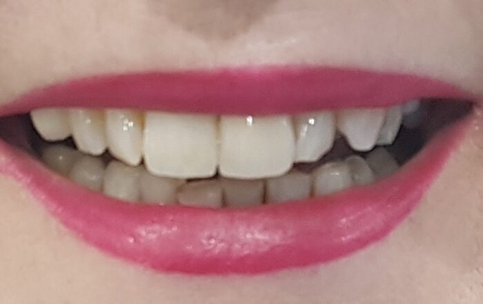 After - Denpure Dental