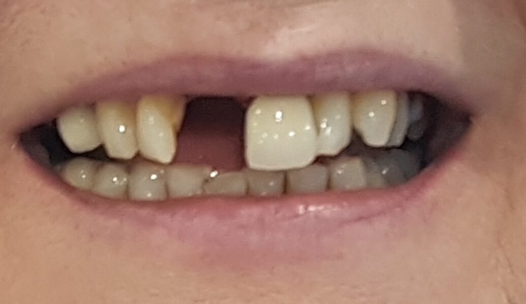 Before - Denpure Dental