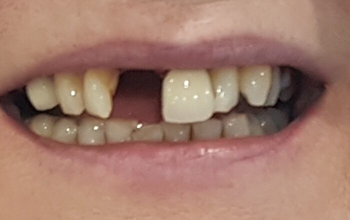 Before - Denpure Dental