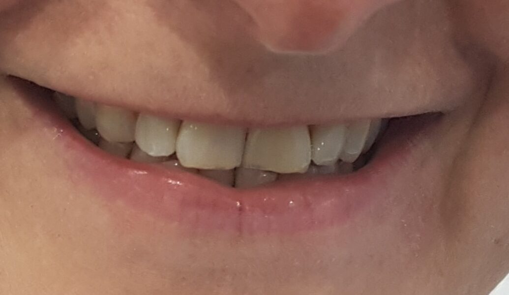 After - Denpure Dental