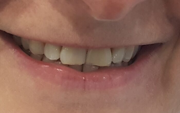 After - Denpure Dental