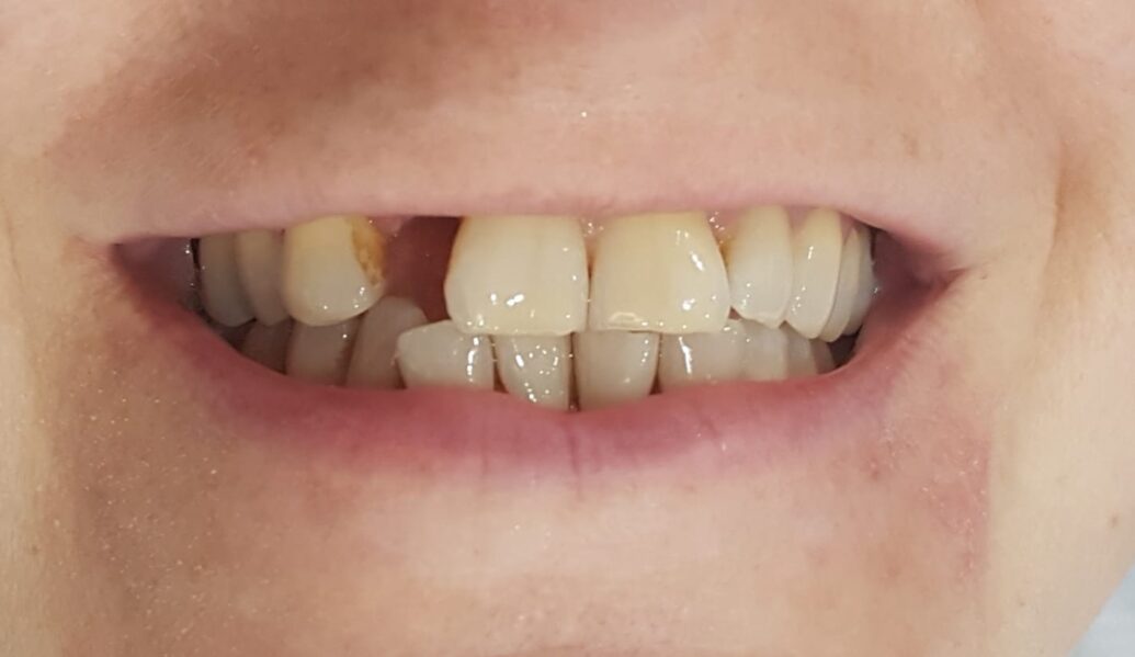 Before - Denpure Dental