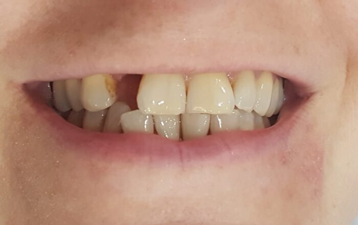 Before - Denpure Dental